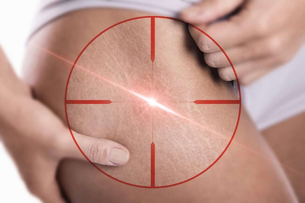 Technology 6 Close Up,of,female,hips,with,a,stretch,marks,during,laser